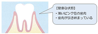 健康な歯肉図