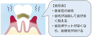 歯周炎の図