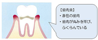 歯肉炎の図