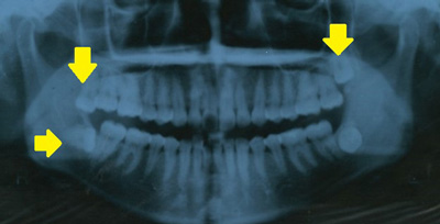 パノラマ矢印つきレントゲン写真